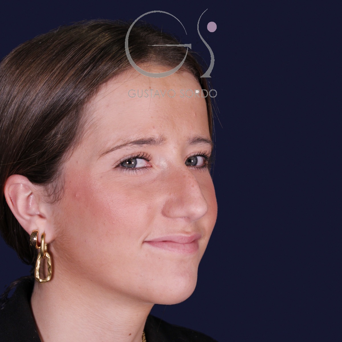 Rinoplastia estructural con dorso en S y spreader grafts, semiperfil derecho: antes de la operación