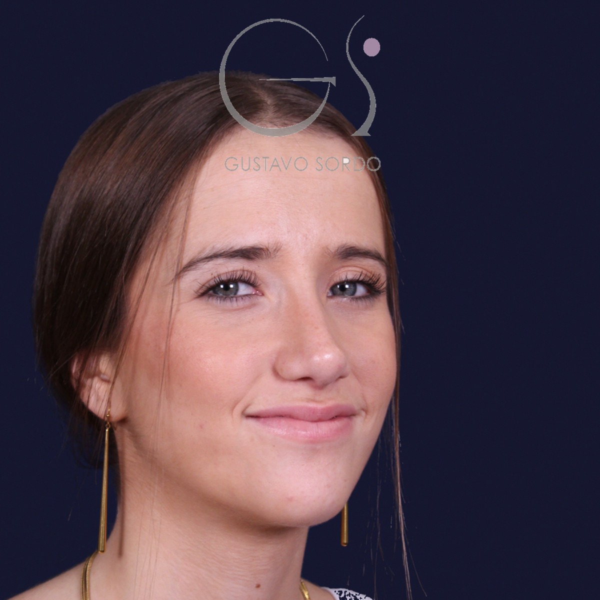 Rinoplastia estructural con dorso en S y spreader grafts, semiperfil derecho: resultado a los 17 meses