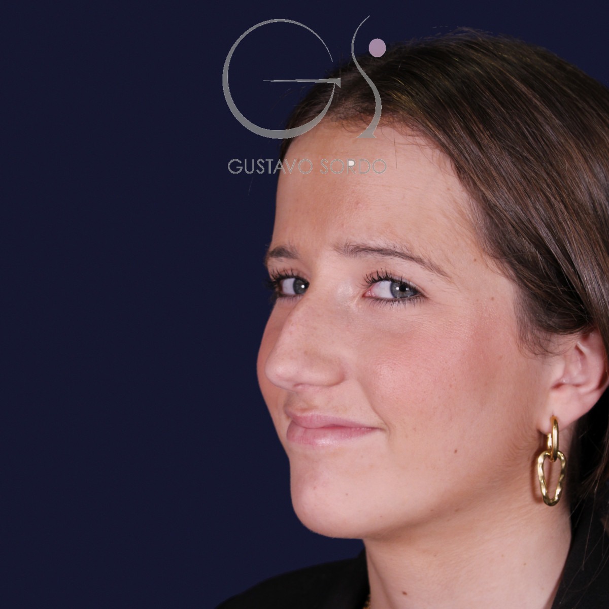 Rinoplastia estructural con dorso en S y spreader grafts, semiperfil izquierdo: antes de la operación