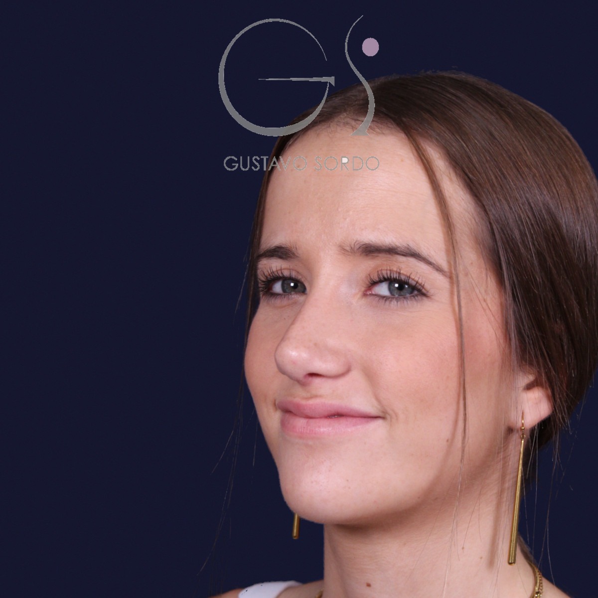 Rinoplastia estructural con dorso en S y spreader grafts, semiperfil izquierdo: resultado a los 17 meses