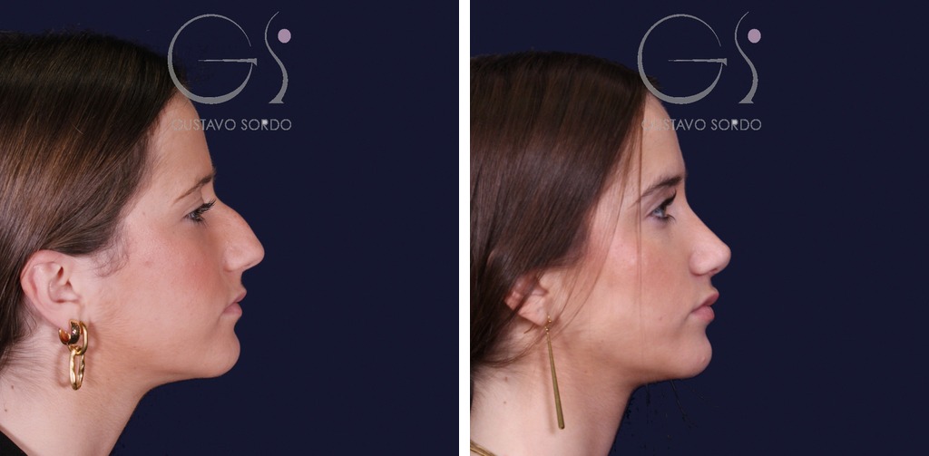 Rinoplastia estructural con dorso en S: antes y después de un caso operado en Madrid