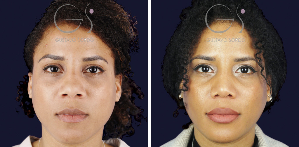 Rinoplastia étnica con alarplastia: antes y a los once meses, vista frontal