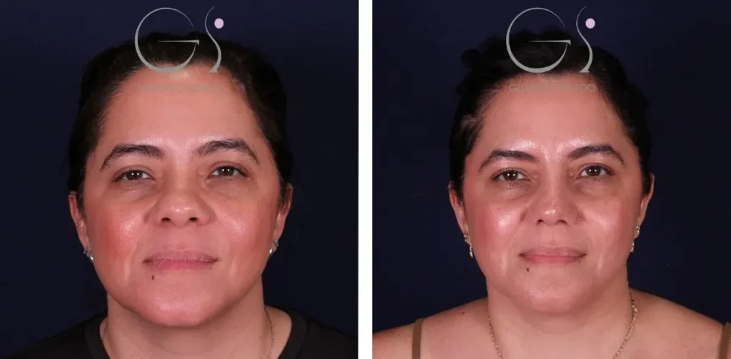 Rhinoplastie — ethnique à Madrid