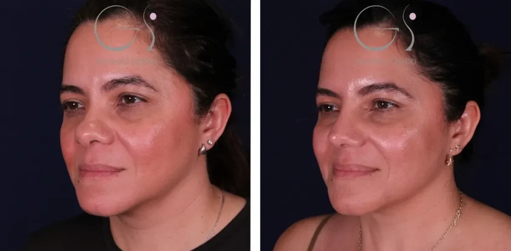 Rhinoplastie — ethnique à Madrid