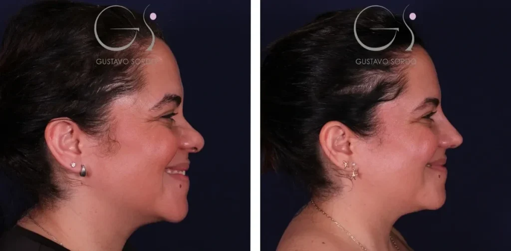 Rhinoplastie — ethnique à Madrid