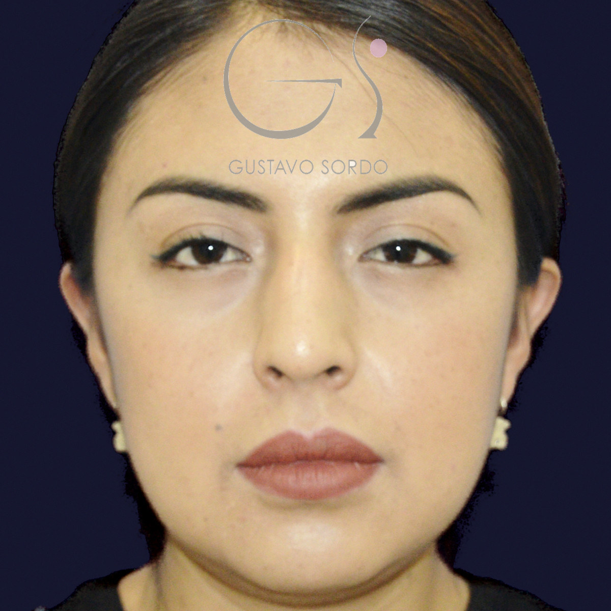 Antes de rinoplastia étnica en nariz latina con la punta corta, vista frontal