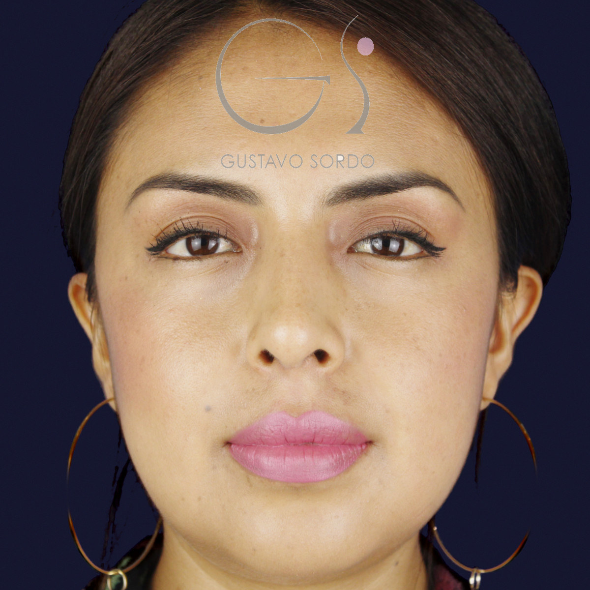 Después de rinoplastia étnica en nariz latina con la punta corta, a los siete meses, vista frontal