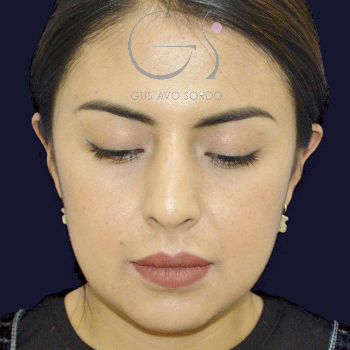 Antes de rinoplastia étnica en nariz latina con la punta corta, vista frontal con el mentón abajo