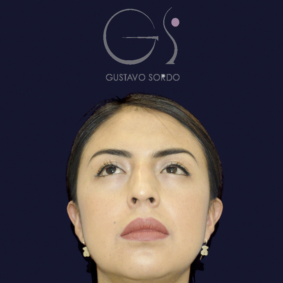 Antes de rinoplastia étnica en nariz latina con la punta corta, vista frontal con el mentón arriba