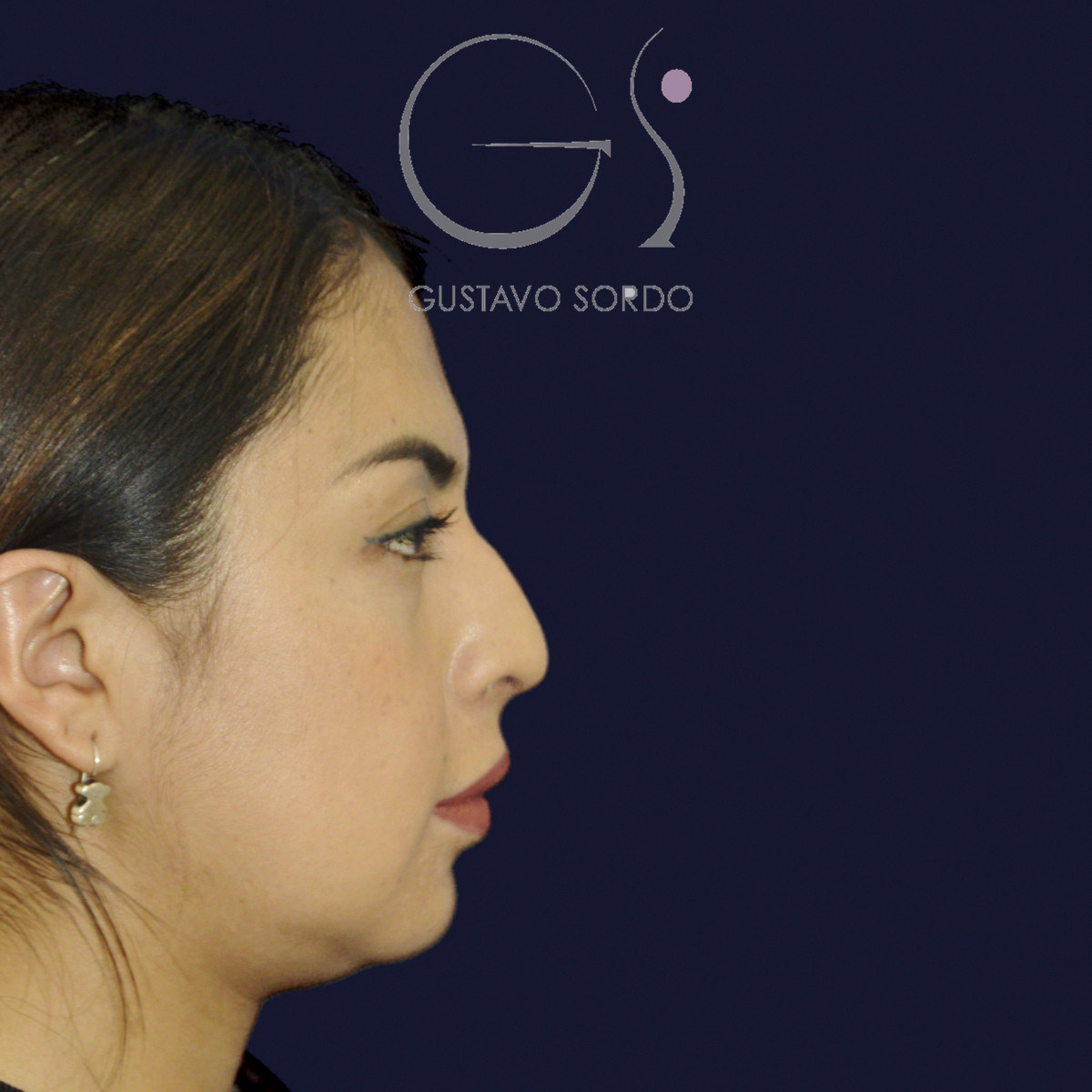 Antes de rinoplastia étnica en nariz latina con la punta corta, vista de perfil derecho