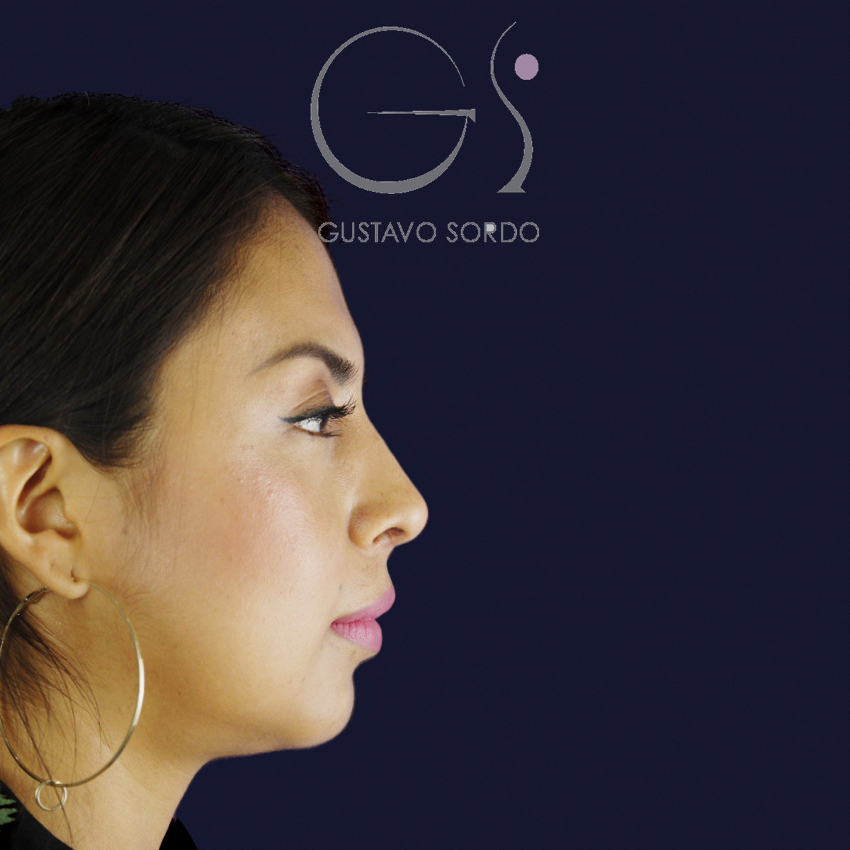 Después de rinoplastia étnica en nariz latina con la punta corta, a los siete meses, vista de perfil derecho