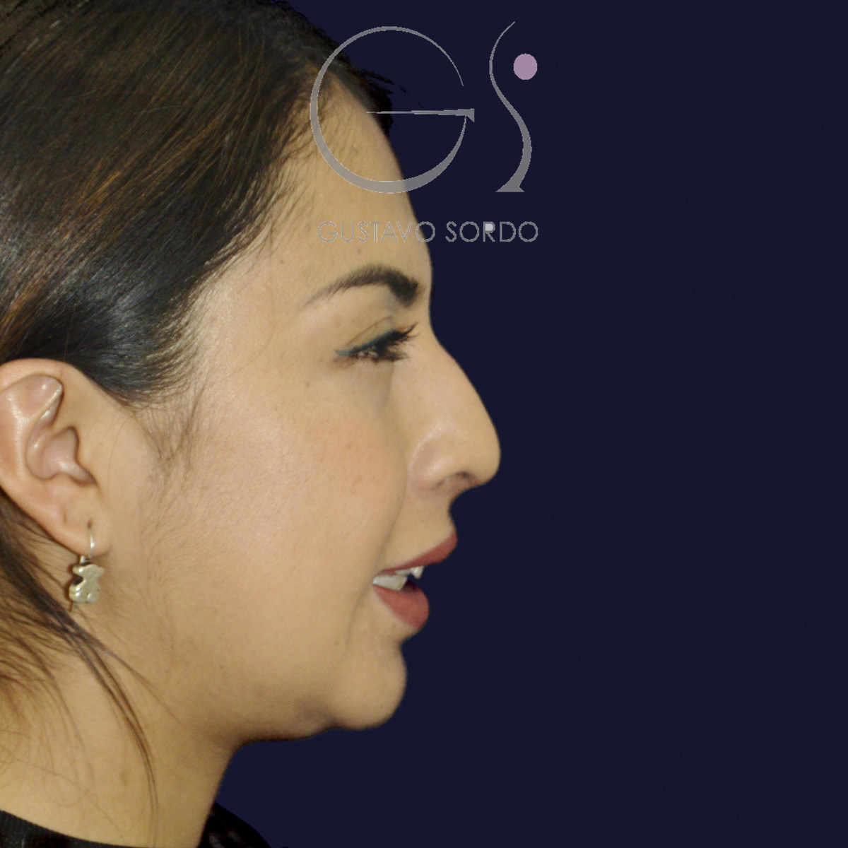 Antes de rinoplastia étnica en nariz latina con la punta corta, vista de perfil derecho sonriendo