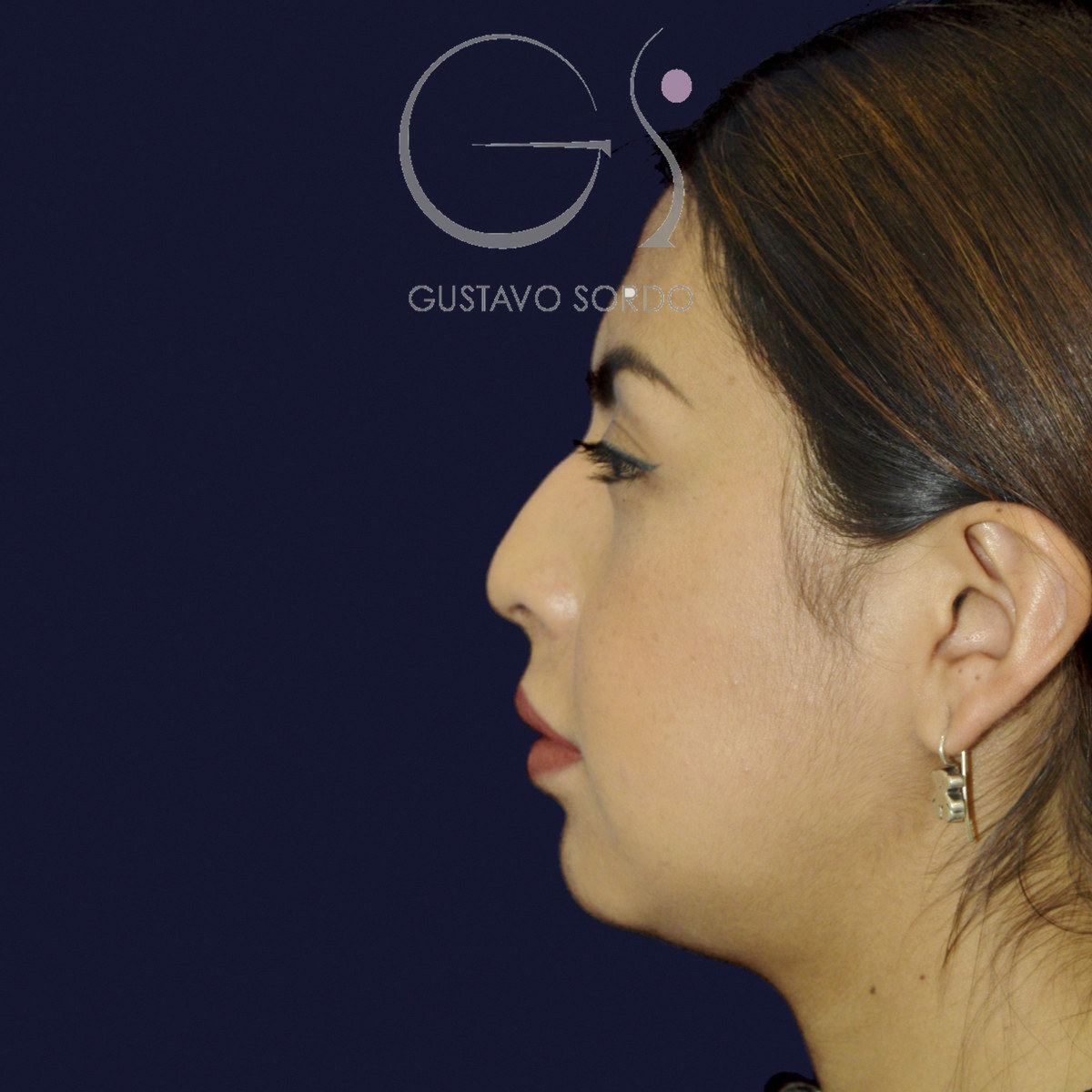 Antes de rinoplastia étnica en nariz latina con la punta corta, vista de perfil izquierdo