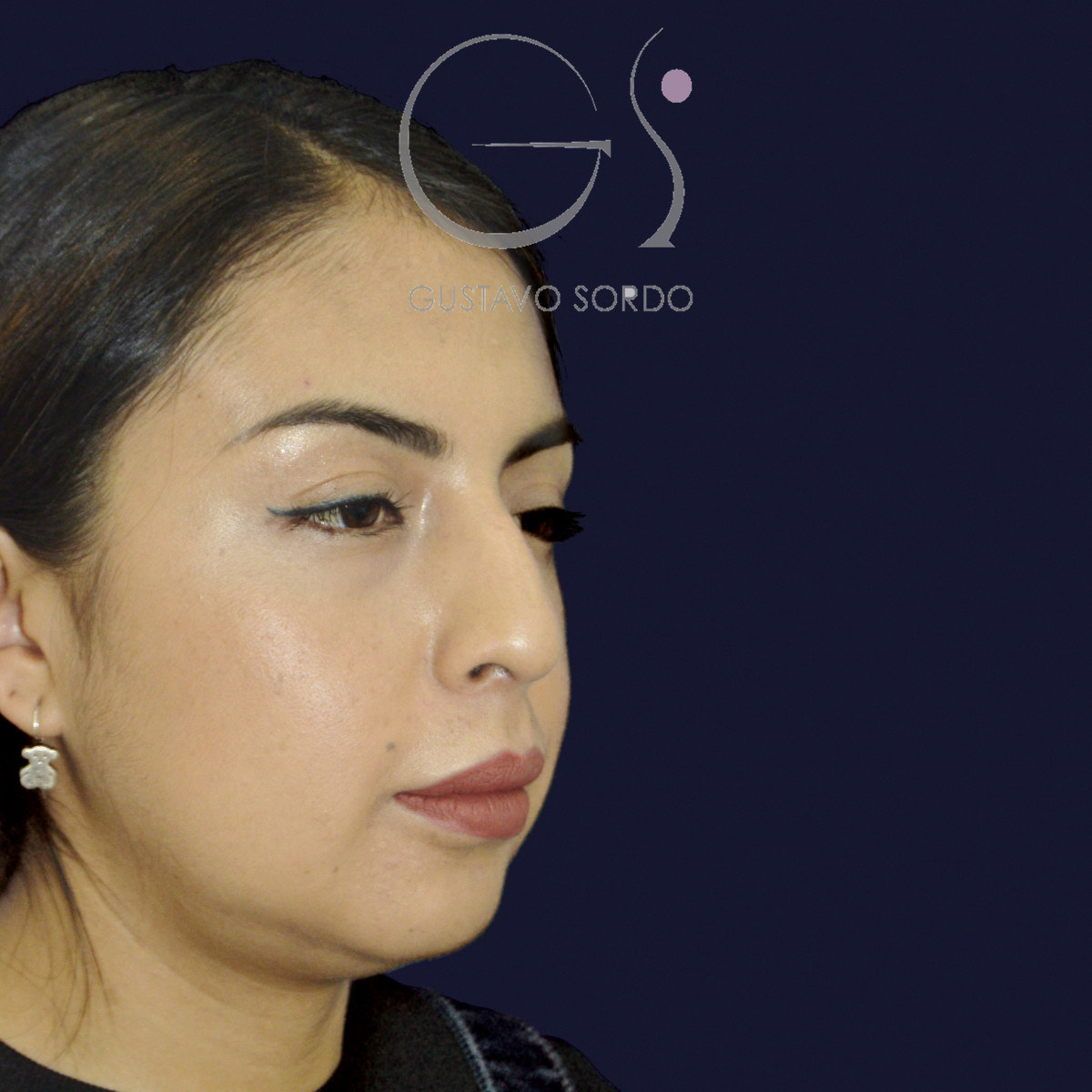 Antes de rinoplastia étnica en nariz latina con la punta corta, vista de semiperfil derecho