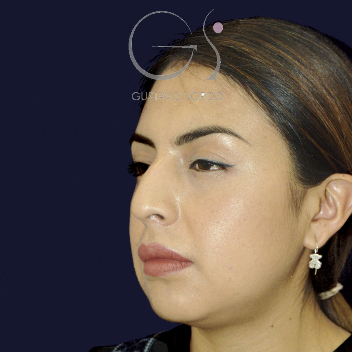 Antes de rinoplastia étnica en nariz latina con la punta corta, vista de semiperfil izquierdo