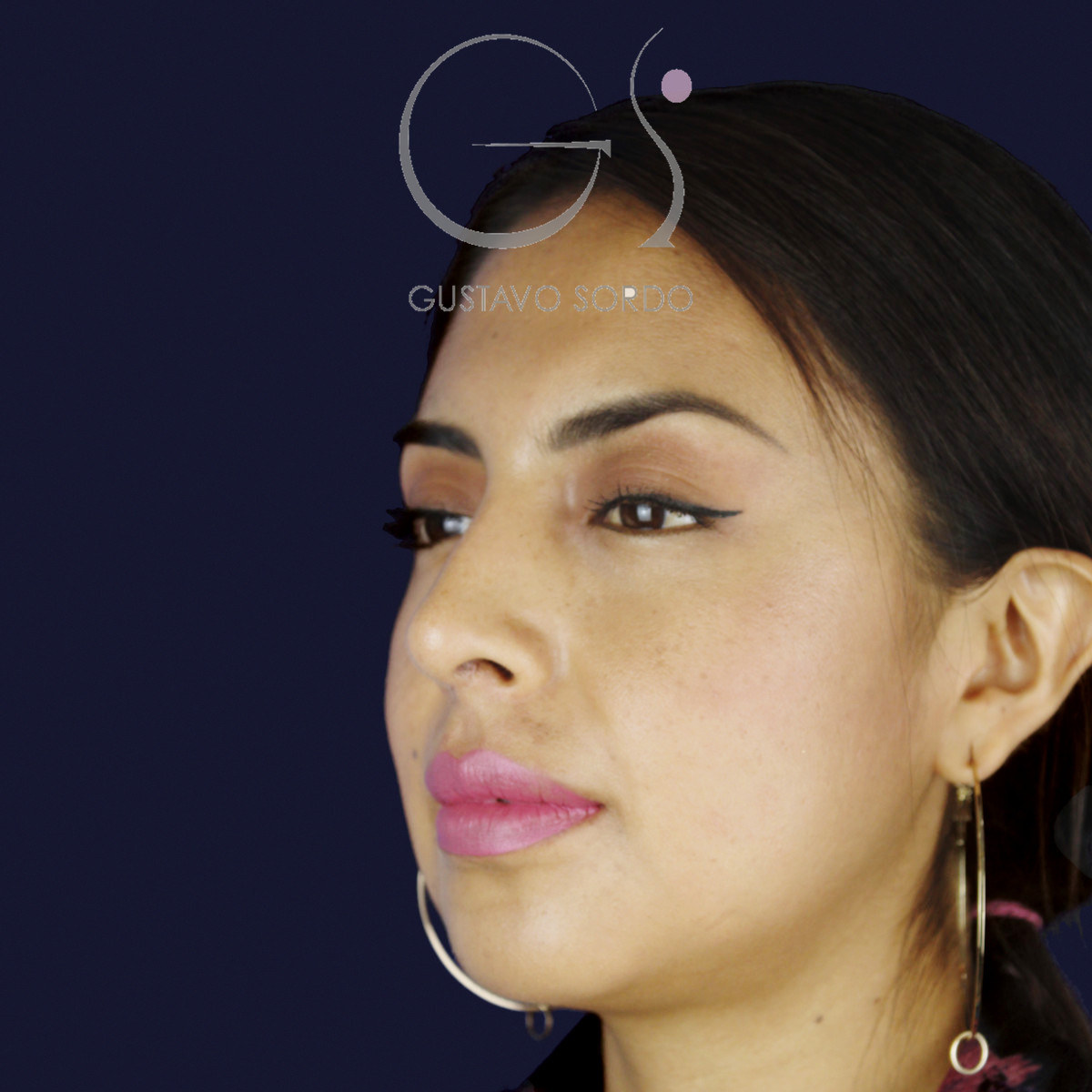 Después de rinoplastia étnica en nariz latina con la punta corta, a los siete meses, vista de semiperfil izquierdo