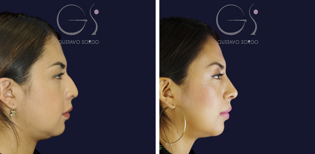 Rinoplastia étnica en nariz latina con la punta corta: antes y a los siete meses, perfil derecho