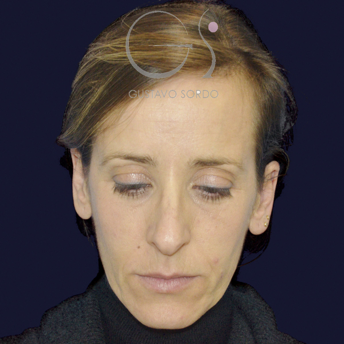 Vor der Nasenkorrektur einer Nase mit Höcker und hängender Columella, Vorderansicht mit gesenktem Kinn.