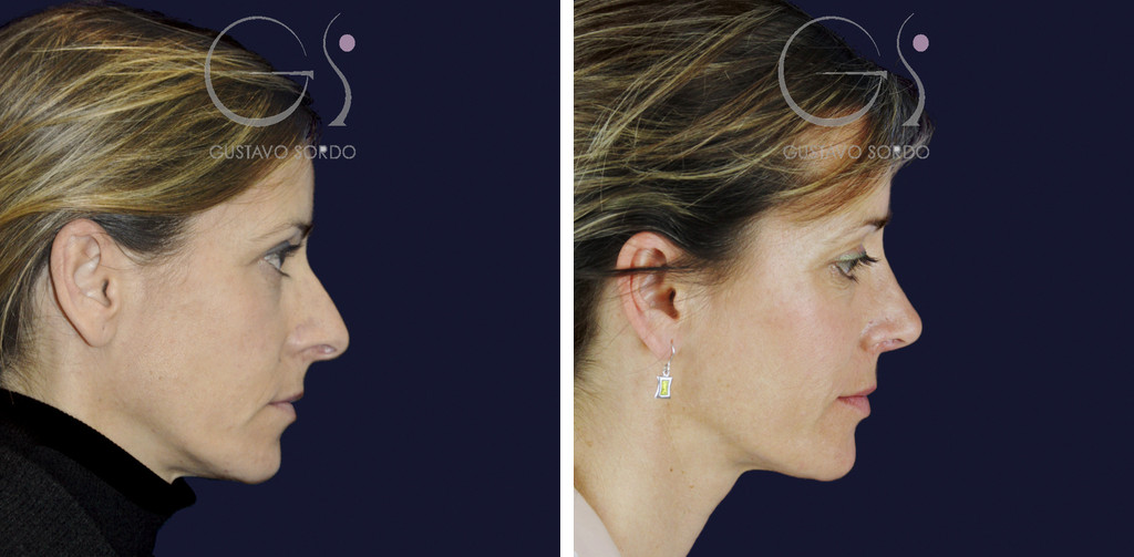 Rinoplastia en nariz con giba y columela colgante: antes y a los cinco meses, perfil derecho