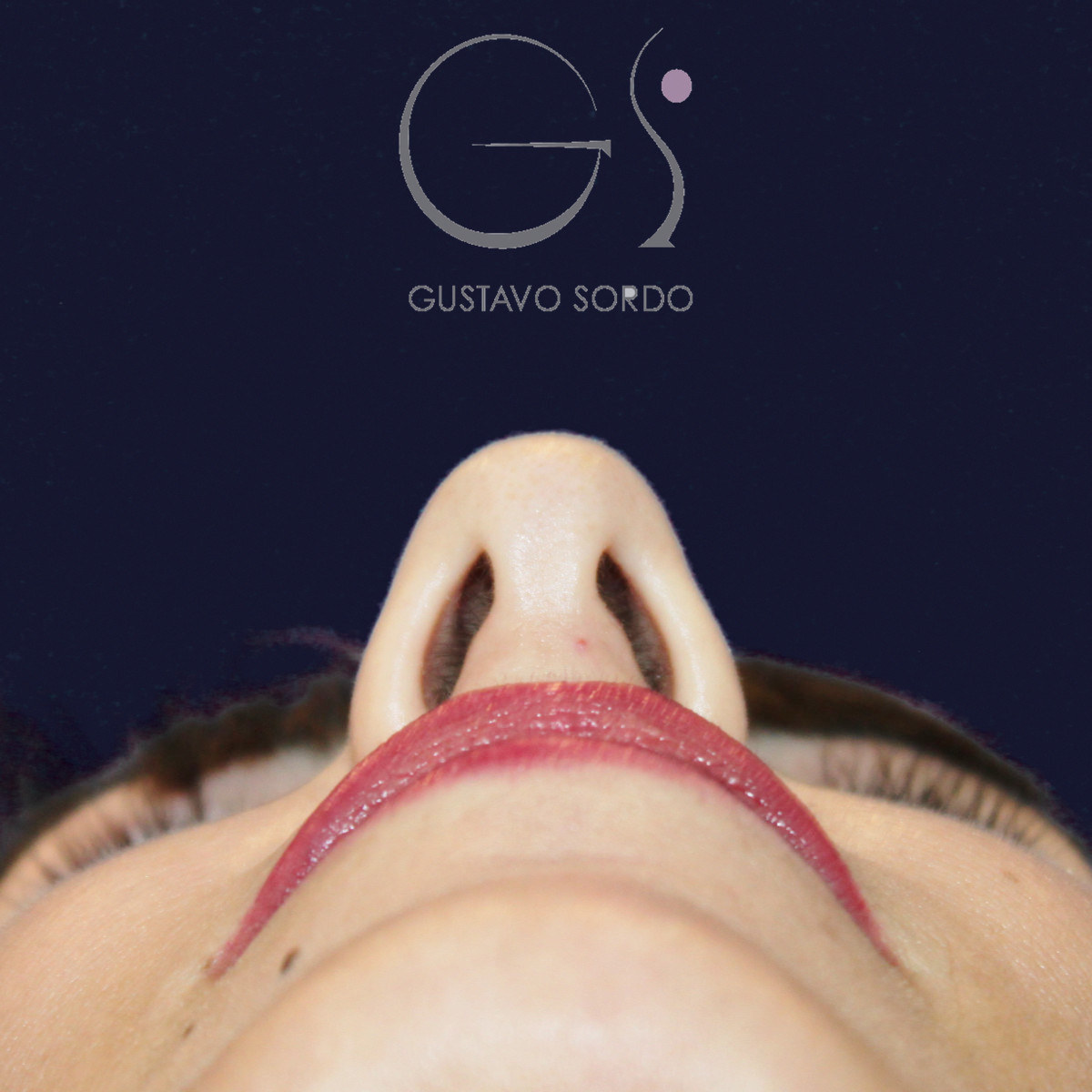 Before reduction rhinoplasty for large hump and wide nose, basal view