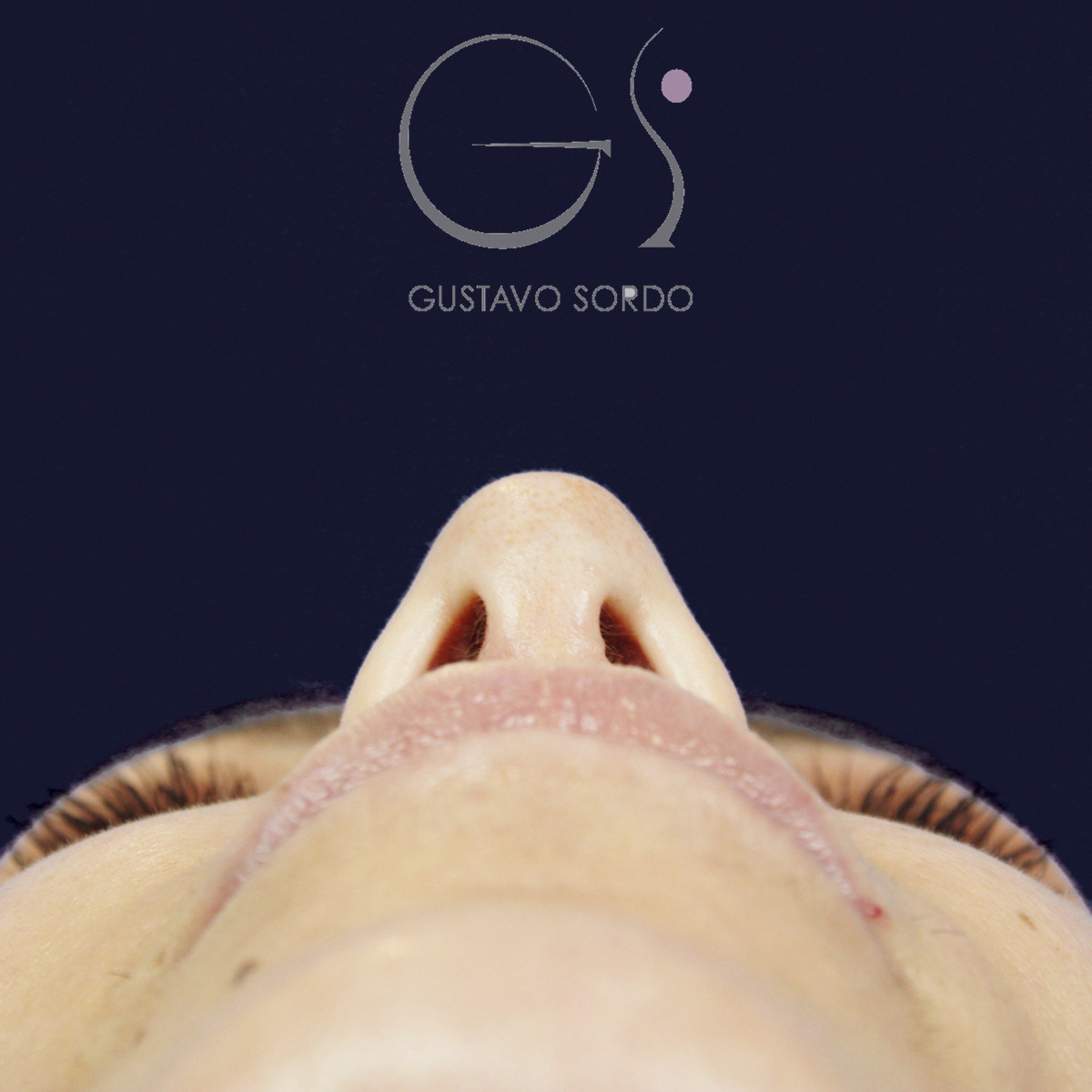 After rhinoplasty to reduce a large hump and wide nose, at two and a half years, baseline view
