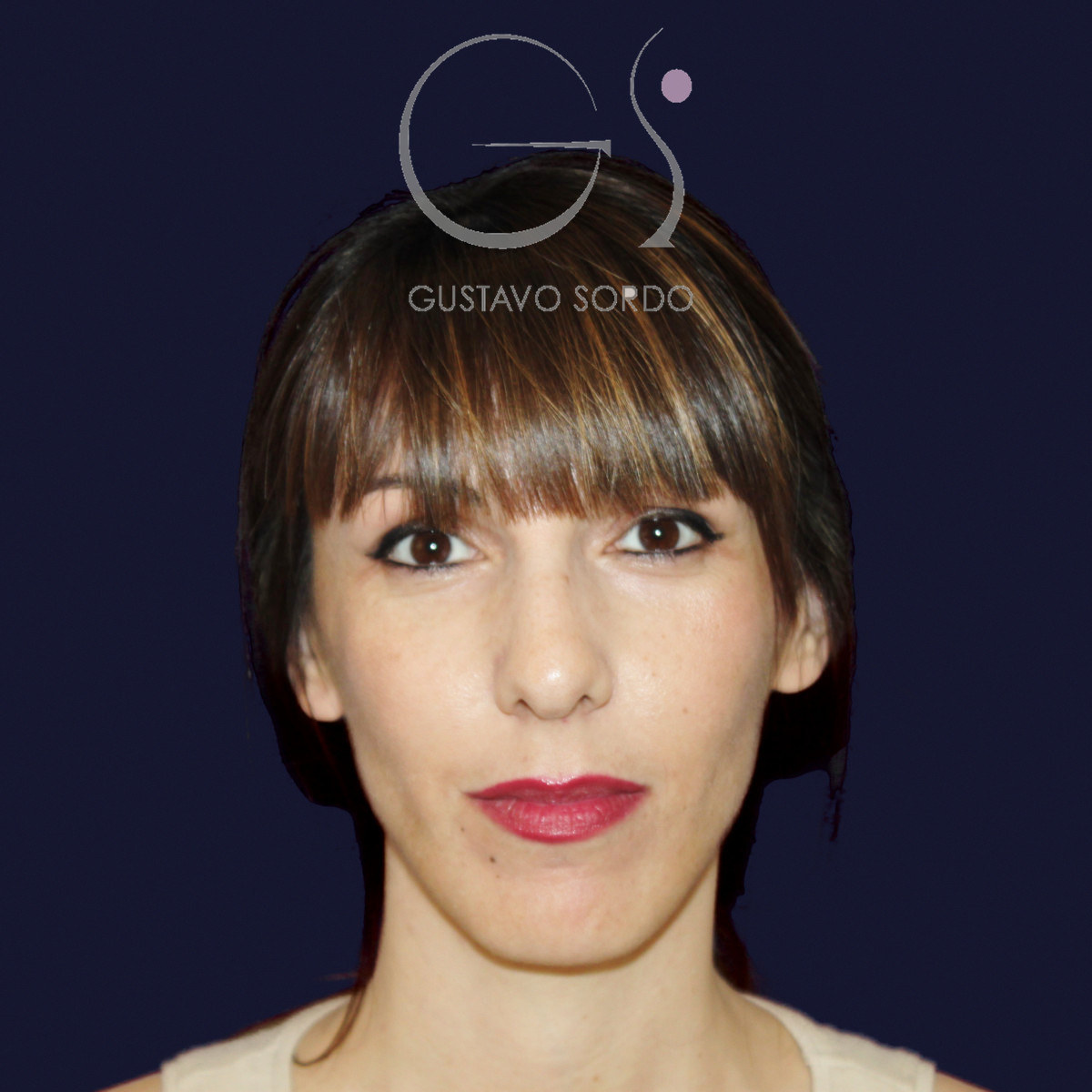 Before rhinoplasty for reduction of large hump and wide nose, front view