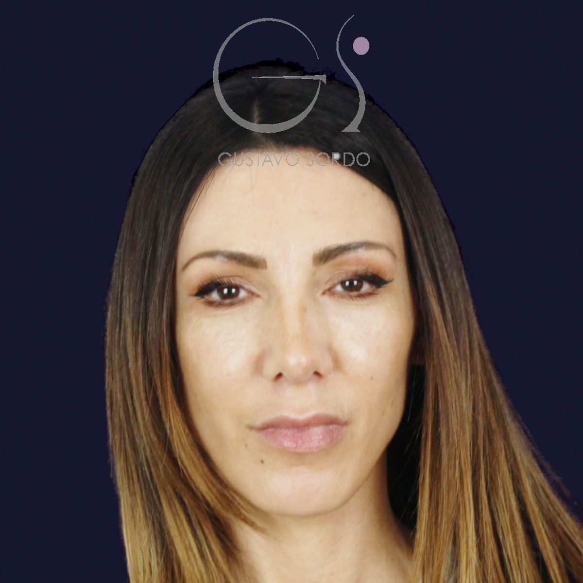 Two and a half years after rhinoplasty to reduce a large hump and wide nose, frontal view