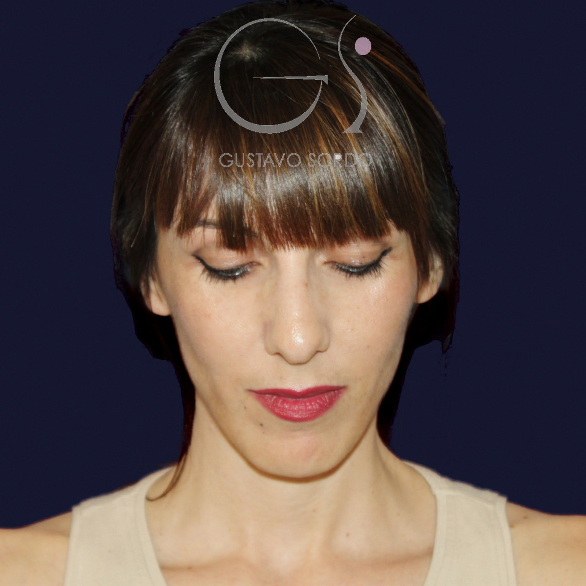 Before rhinoplasty for reduction of large hump and wide nose, front view with chin down