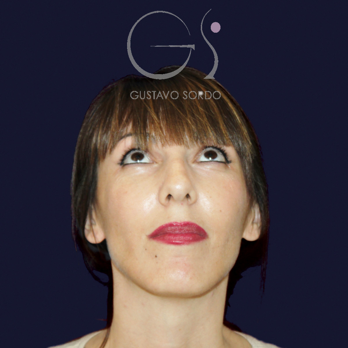 Before rhinoplasty for reduction of large hump and wide nose, front view with chin up