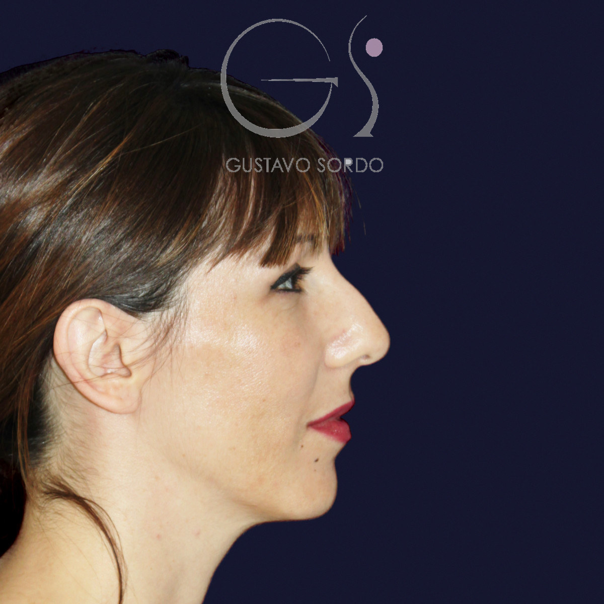 Before rhinoplasty for reduction of large hump and wide nose, right profile view