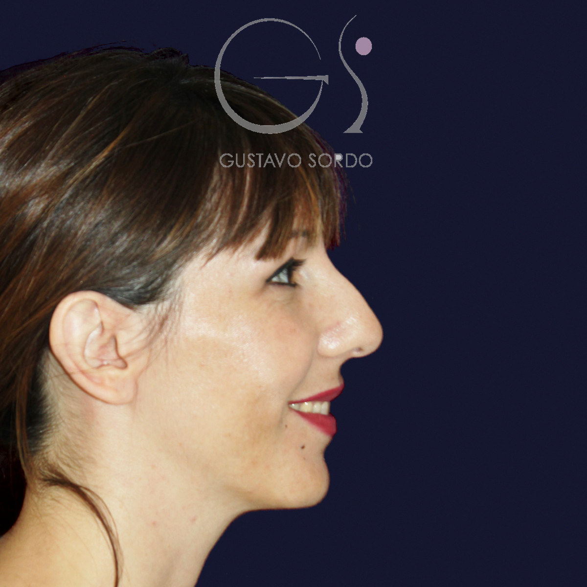 Before rhinoplasty to reduce a large hump and wide nose, right profile view smiling