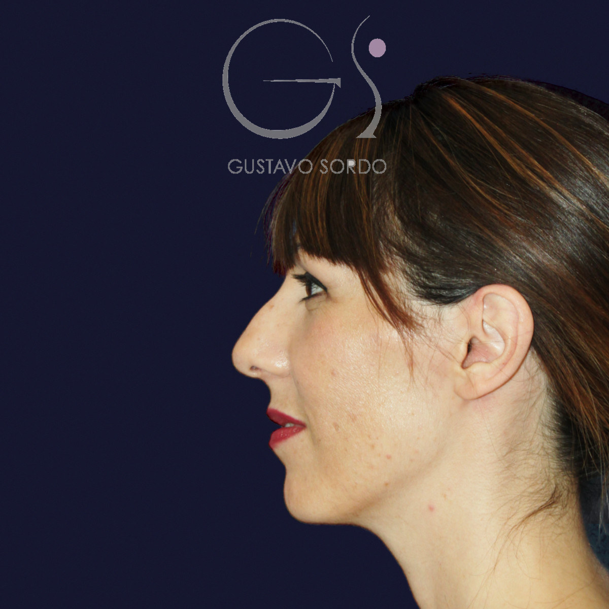 Before rhinoplasty for reduction of large hump and wide nose, left profile view