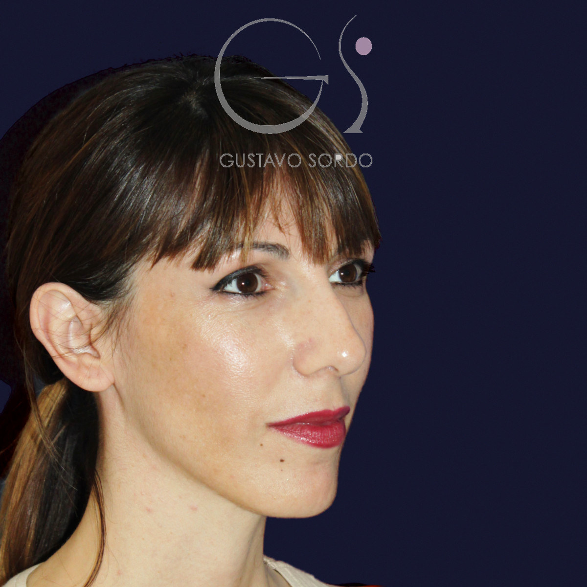 Before rhinoplasty for reduction of large hump and wide nose, right semi-profile view
