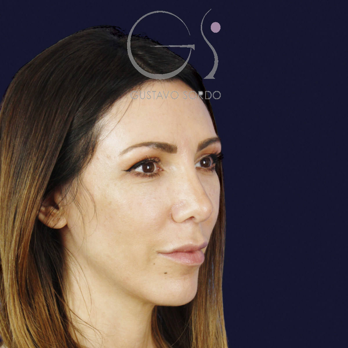 After rhinoplasty to reduce a large hump and wide nose, at two and a half years old, right semi-profile view
