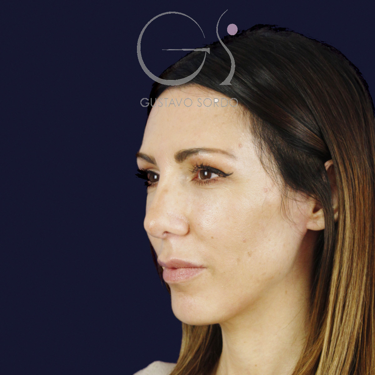 After rhinoplasty to reduce a large hump and wide nose, at two and a half years old, left semi-profile view