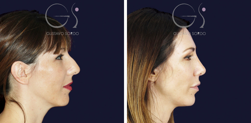 Rinoplastia de reducción en giba grande y nariz ancha: antes y a los dos años y medio, perfil derecho