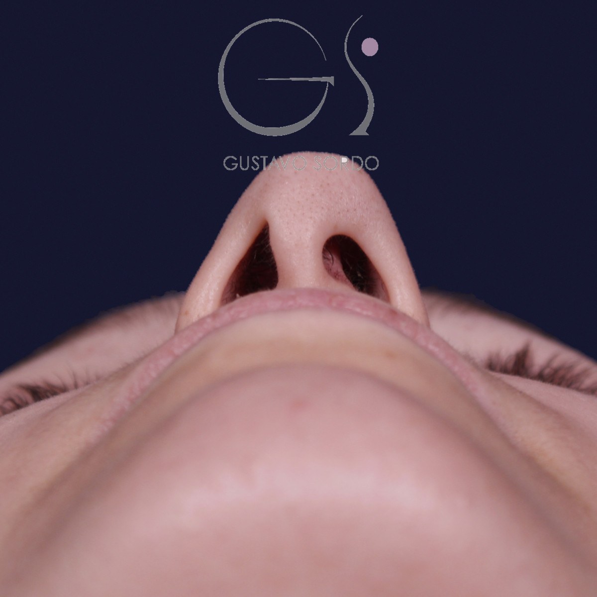 Rinoplastia ultrasónica con giba y punta ancha, vista basal: antes de la operación