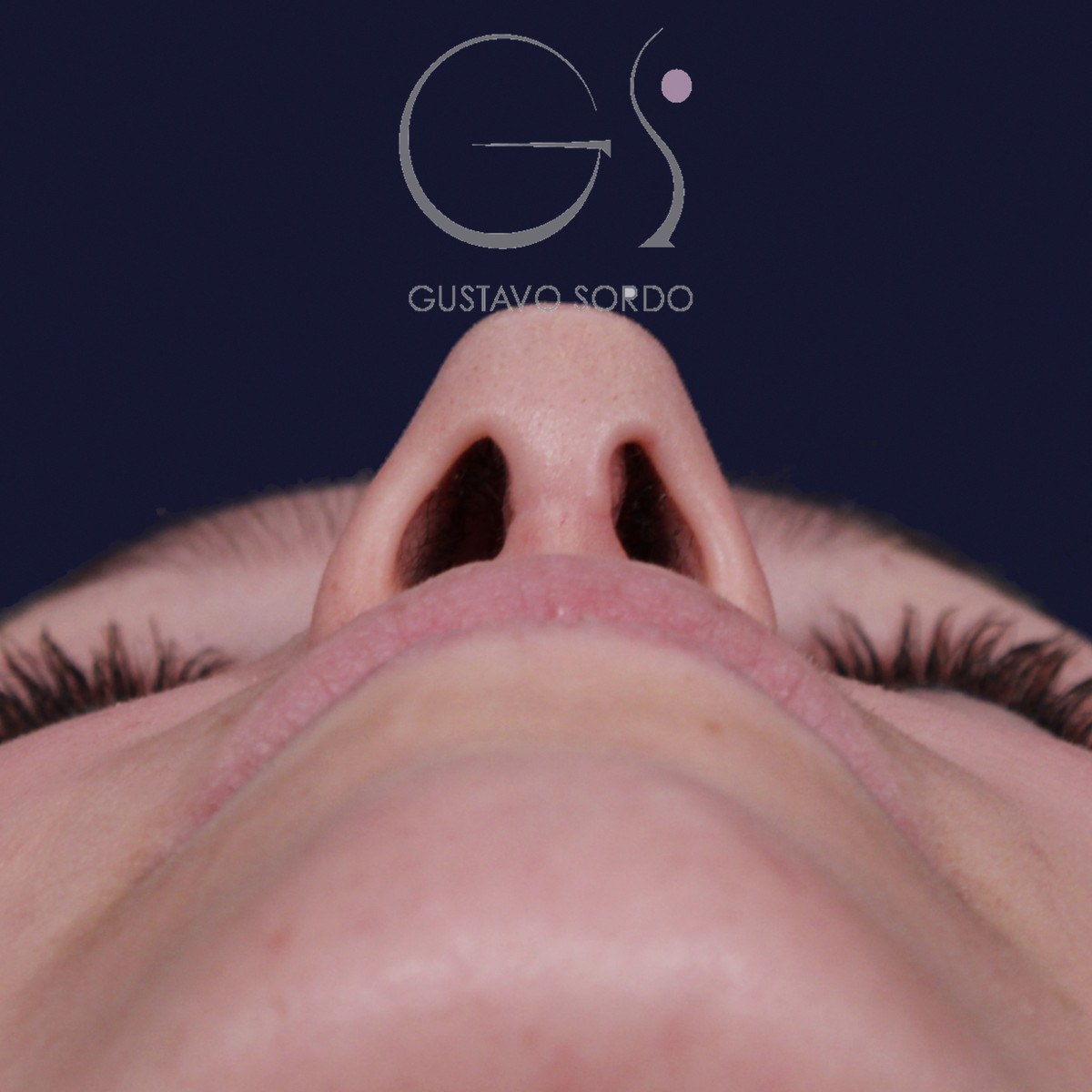 Rinoplastia ultrasónica con giba y punta ancha, vista basal: resultado a los 4 meses