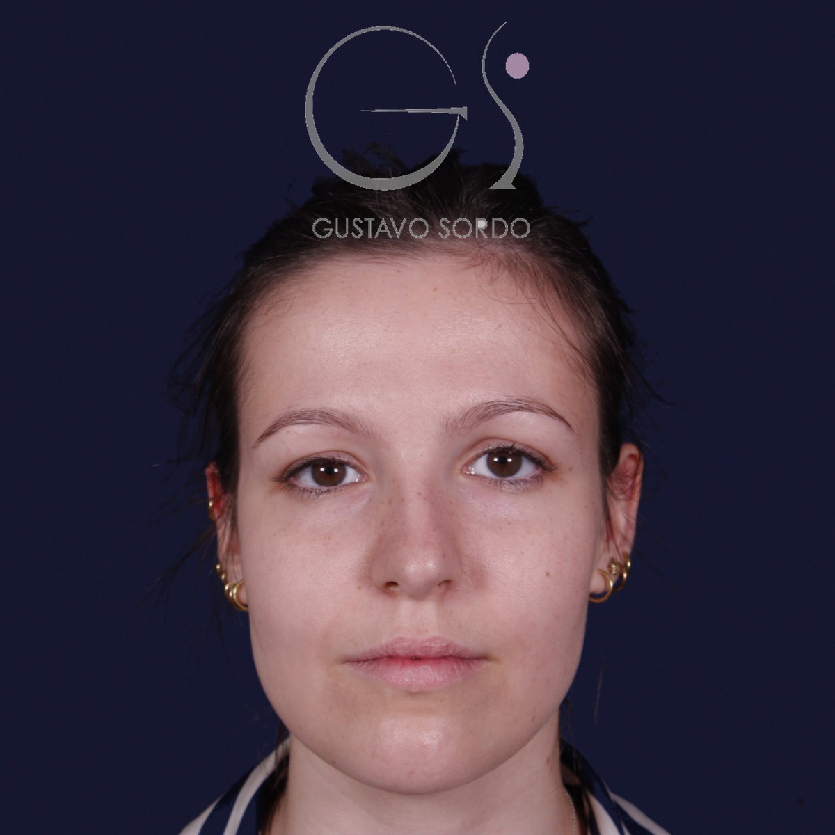 Rinoplastia ultrasónica con giba y punta ancha, de frente: antes de la operación
