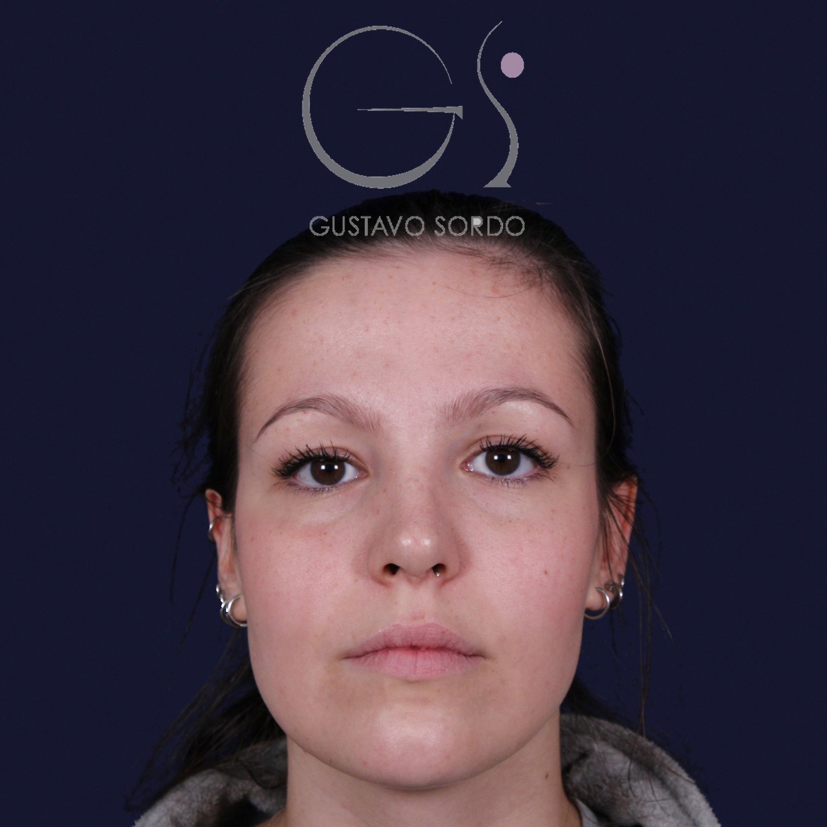 Rinoplastia ultrasónica con giba y punta ancha, de frente: resultado a los 4 meses