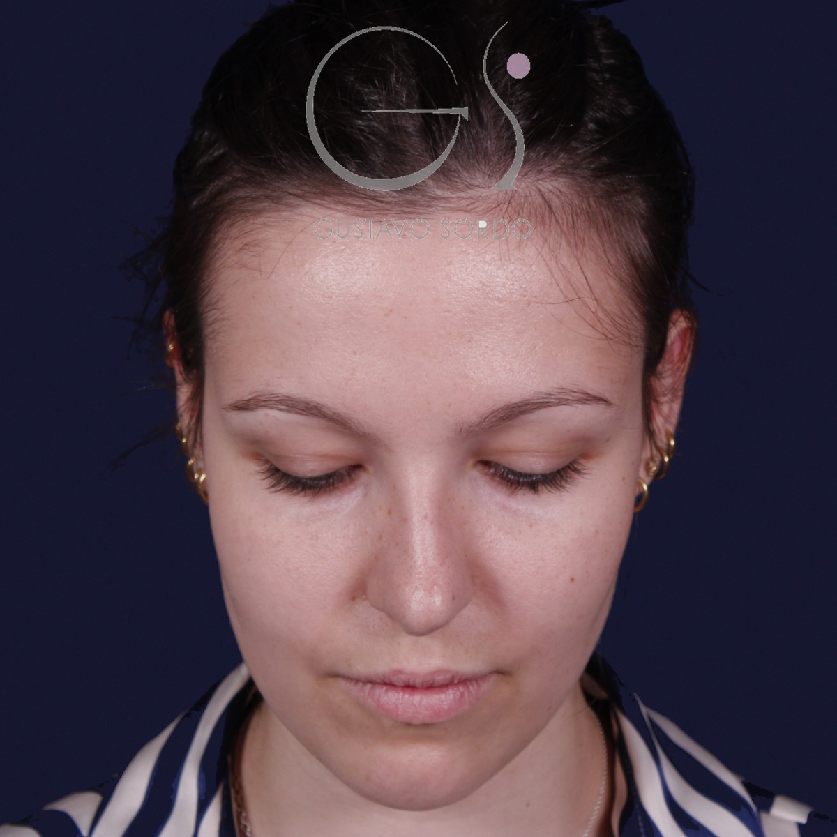 Rinoplastia ultrasónica con giba y punta ancha, mentón abajo: antes de la operación