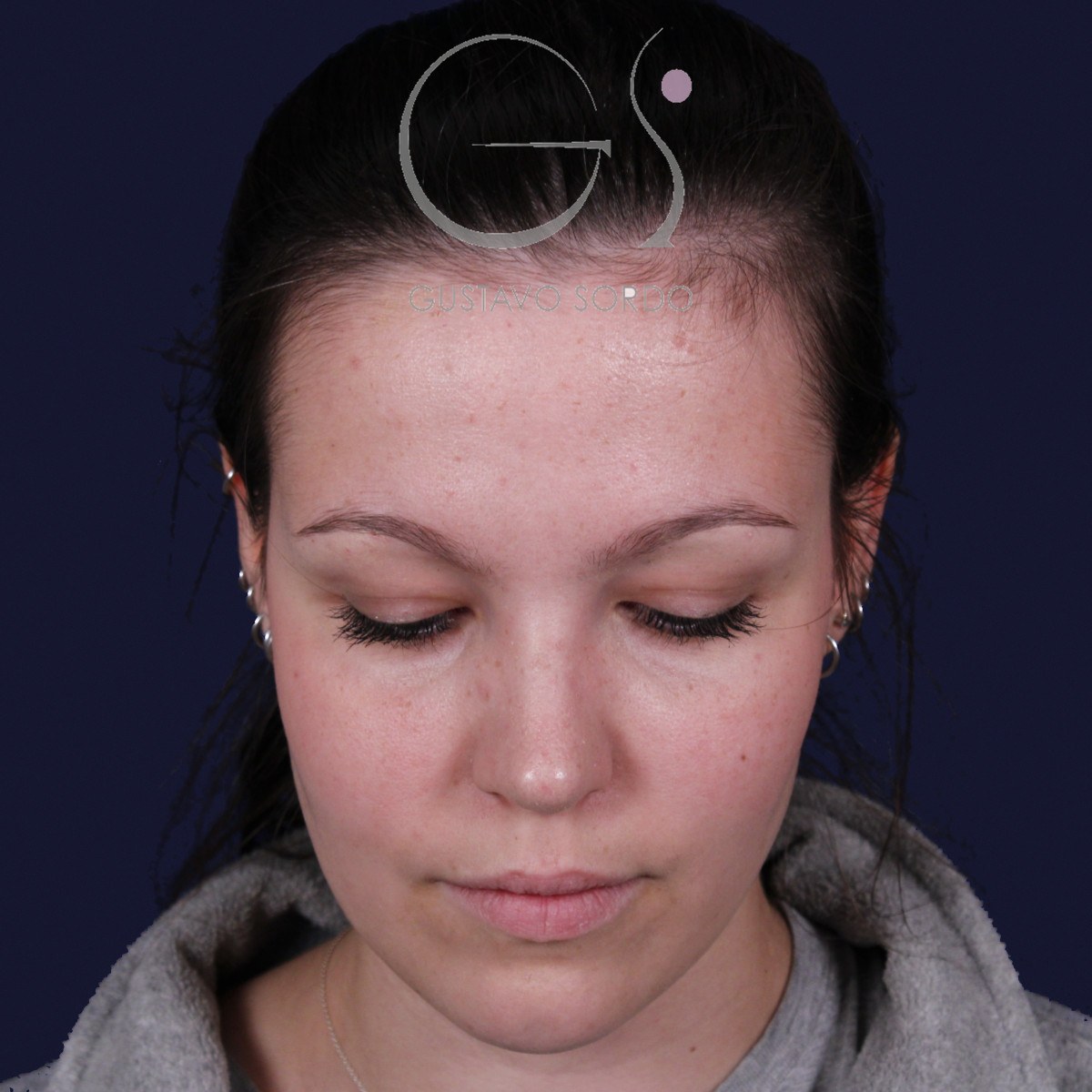 Rinoplastia ultrasónica con giba y punta ancha, mentón abajo: resultado a los 4 meses