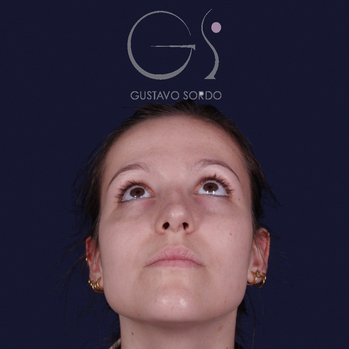 Rinoplastia ultrasónica con giba y punta ancha, mentón arriba: antes de la operación