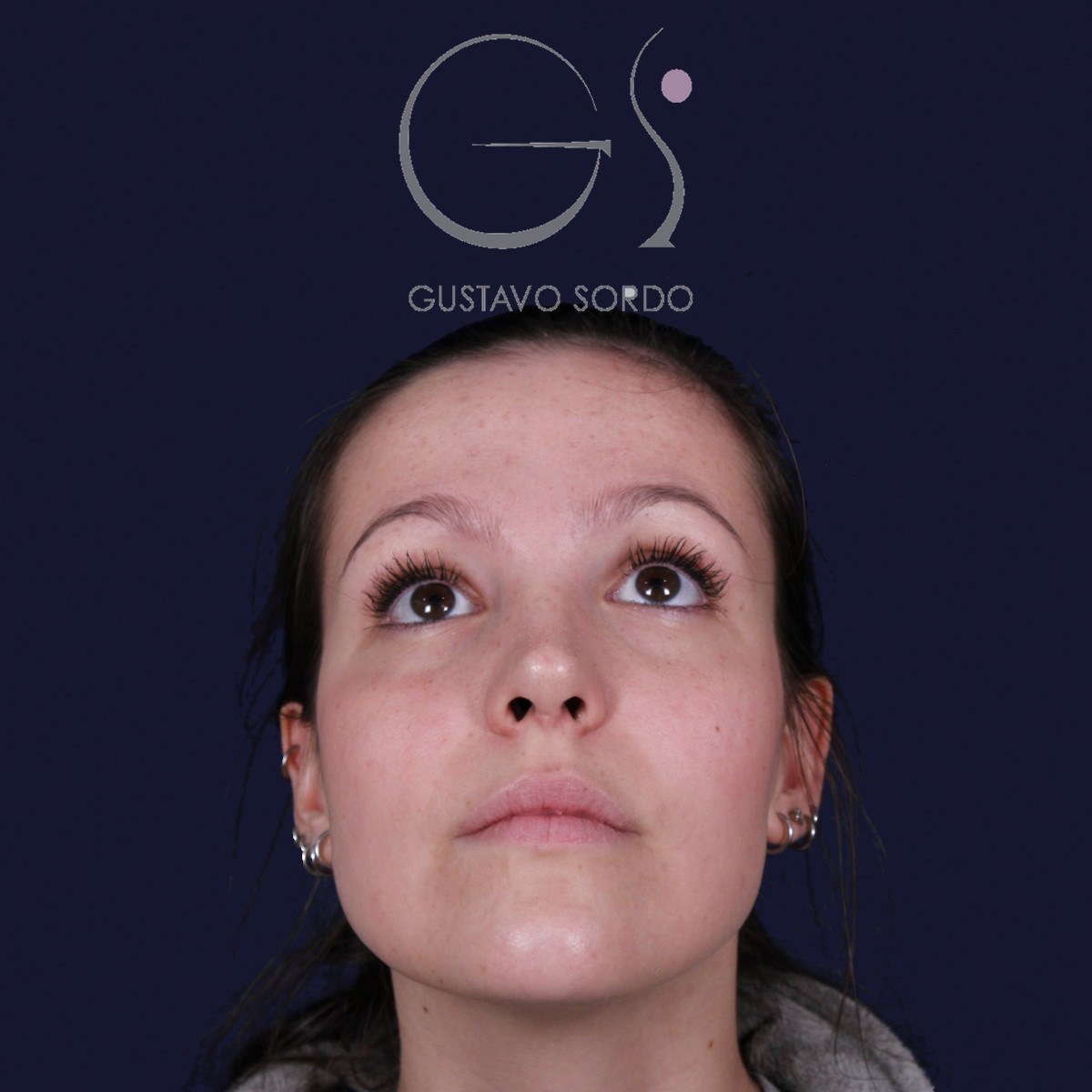 Rinoplastia ultrasónica con giba y punta ancha, mentón arriba: resultado a los 4 meses