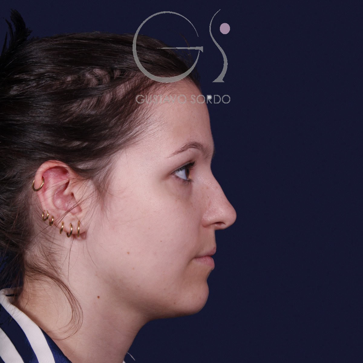Rinoplastia ultrasónica con giba y punta ancha, perfil derecho: antes de la operación