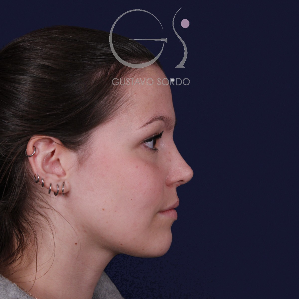 Rinoplastia ultrasónica con giba y punta ancha, perfil derecho: resultado a los 4 meses