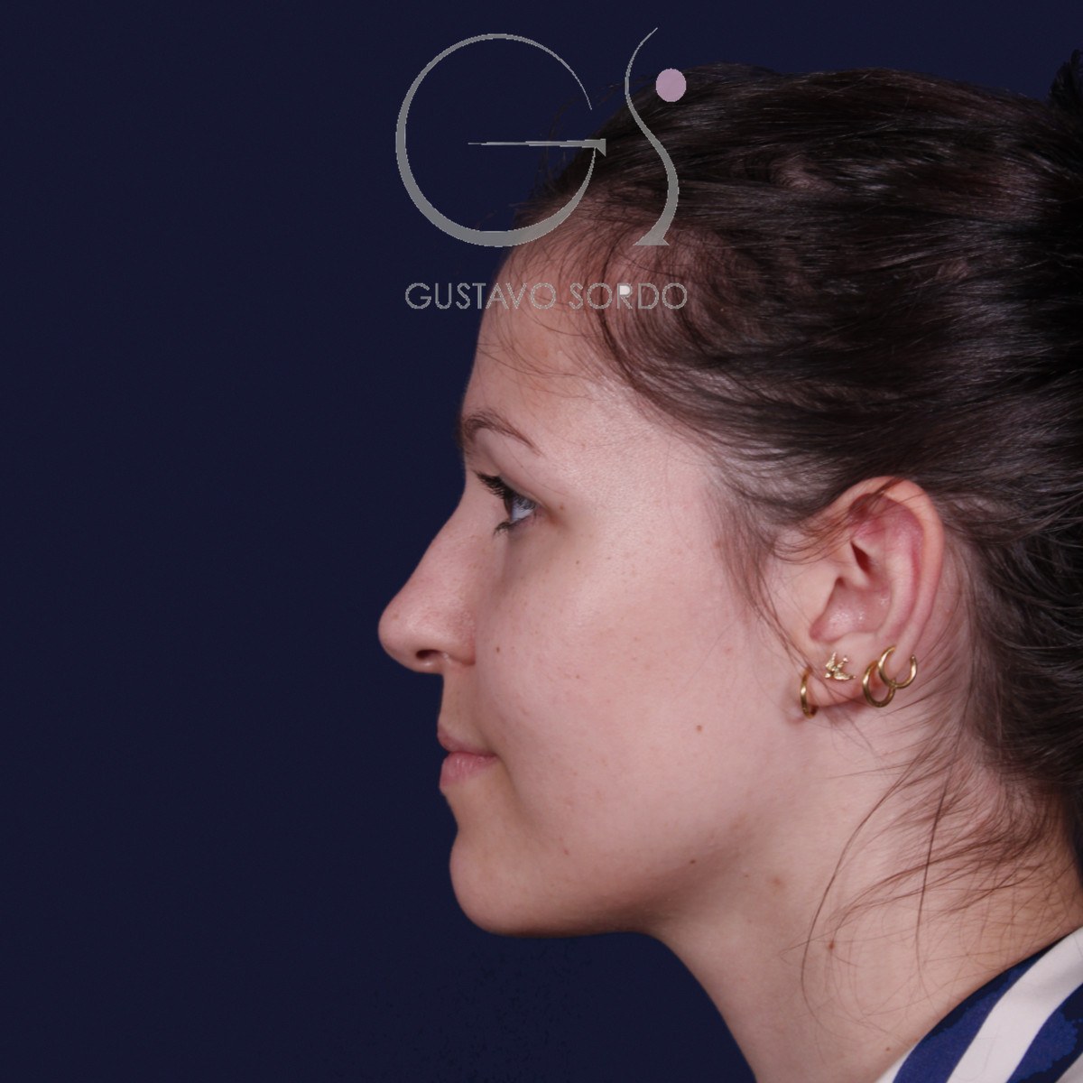 Rinoplastia ultrasónica con giba y punta ancha, perfil izquierdo: antes de la operación