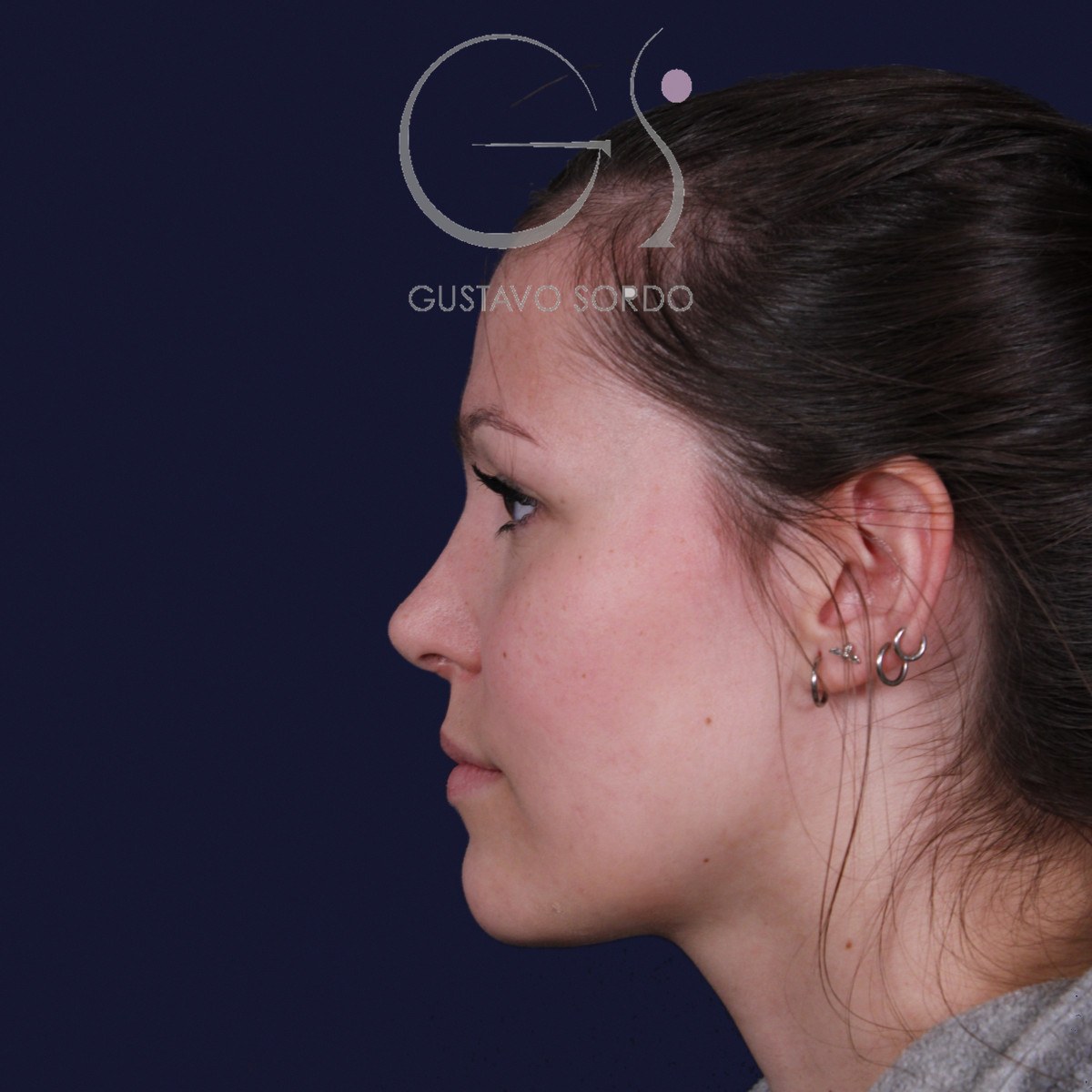 Rinoplastia ultrasónica con giba y punta ancha, perfil izquierdo: resultado a los 4 meses