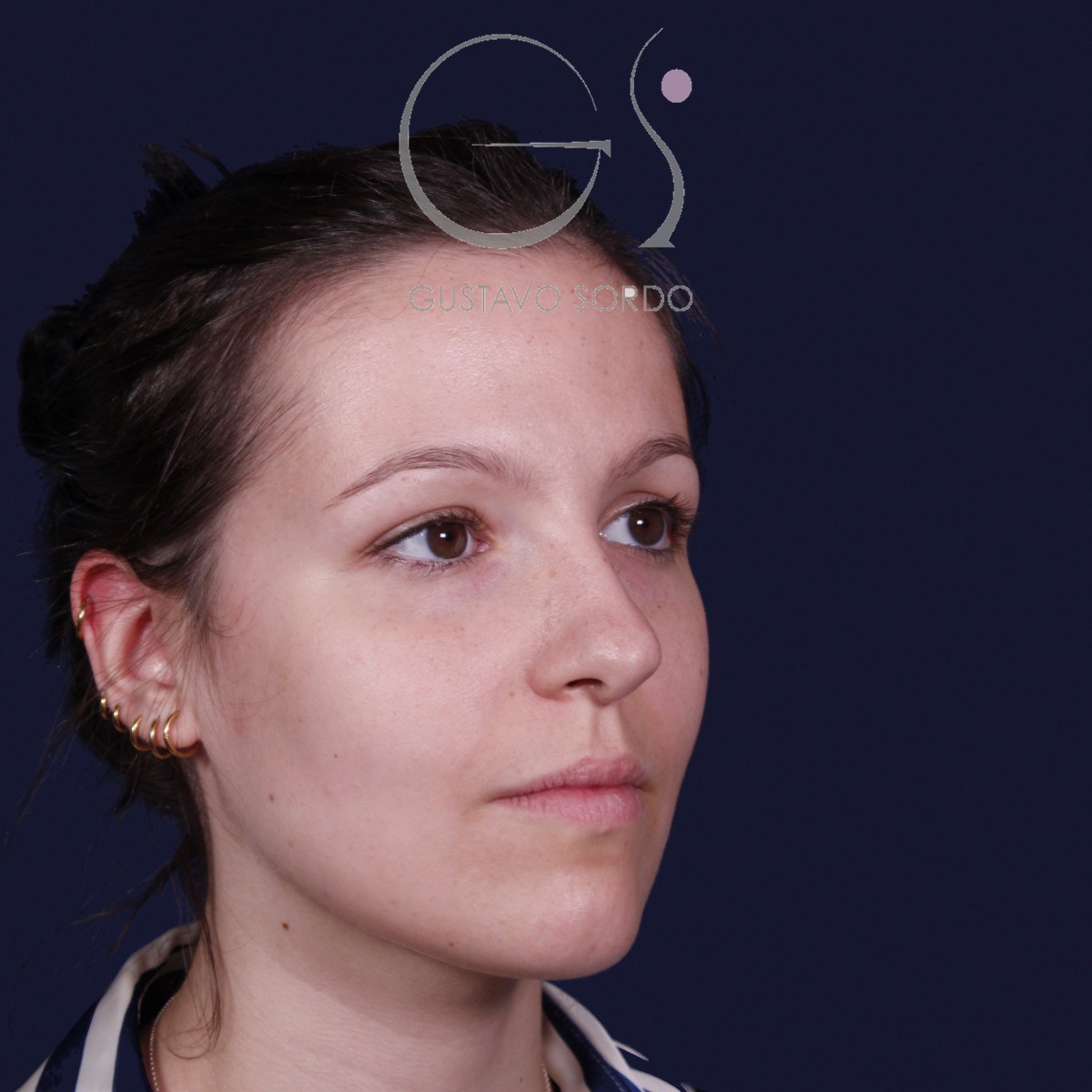 Rinoplastia ultrasónica con giba y punta ancha, semiperfil derecho: antes de la operación