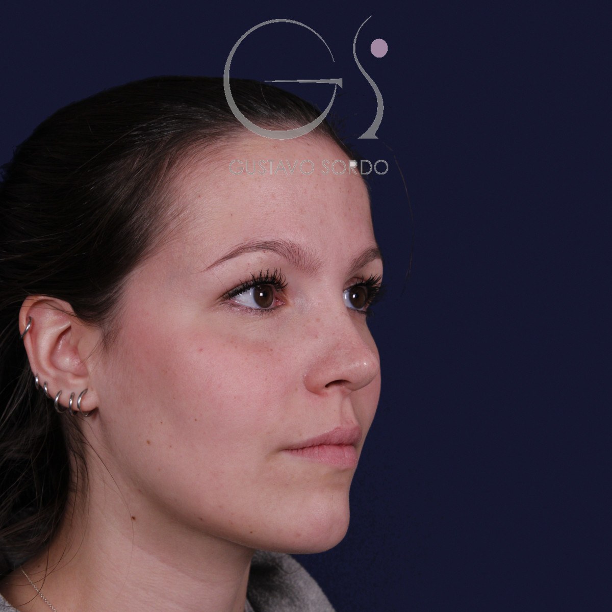Rinoplastia ultrasónica con giba y punta ancha, semiperfil derecho: resultado a los 4 meses
